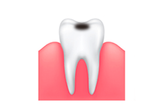 虫歯治療・予防