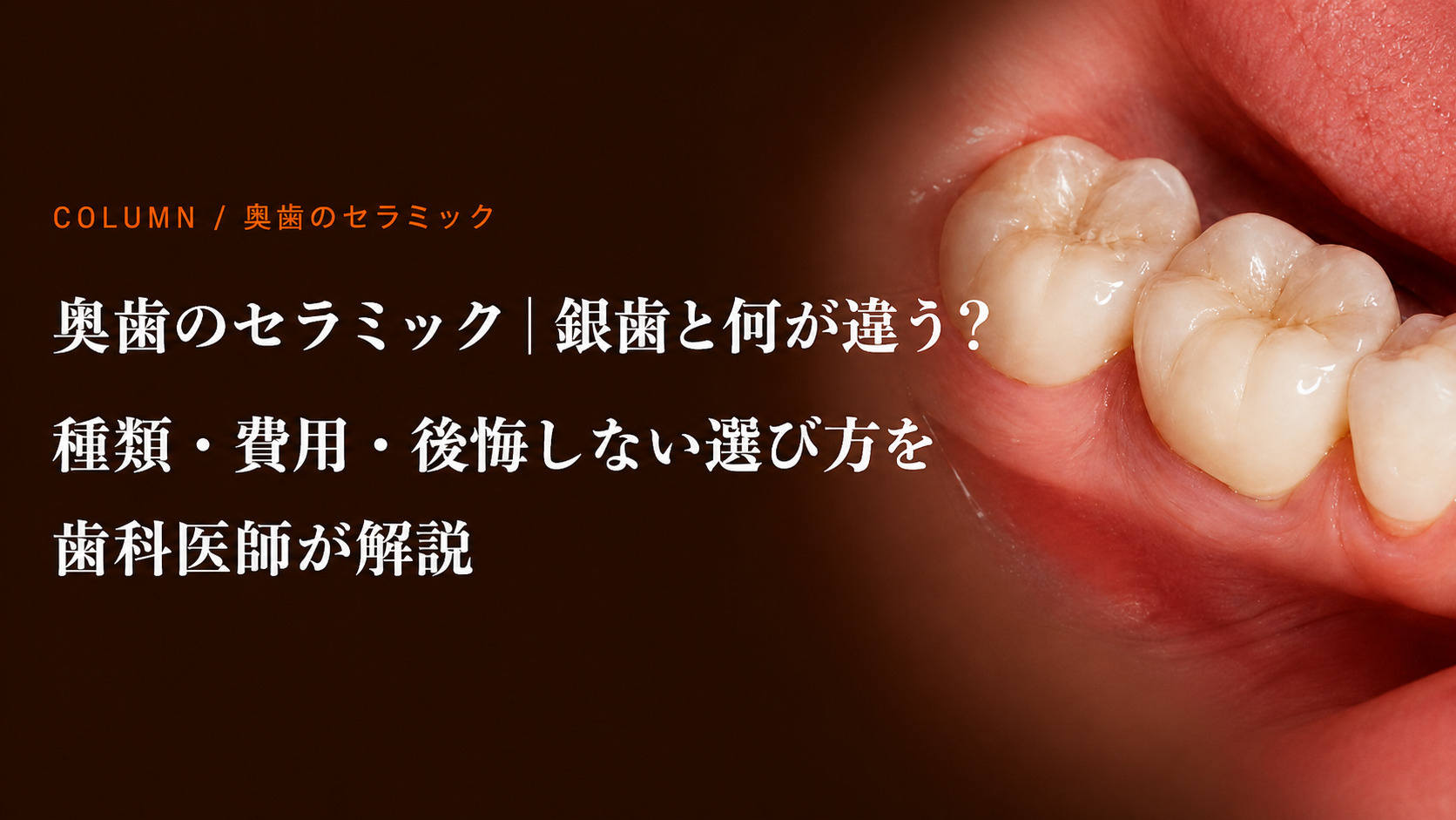 奥歯のセラミック｜銀歯と何が違う？種類・費用・後悔しない選び方を歯科医師が解説