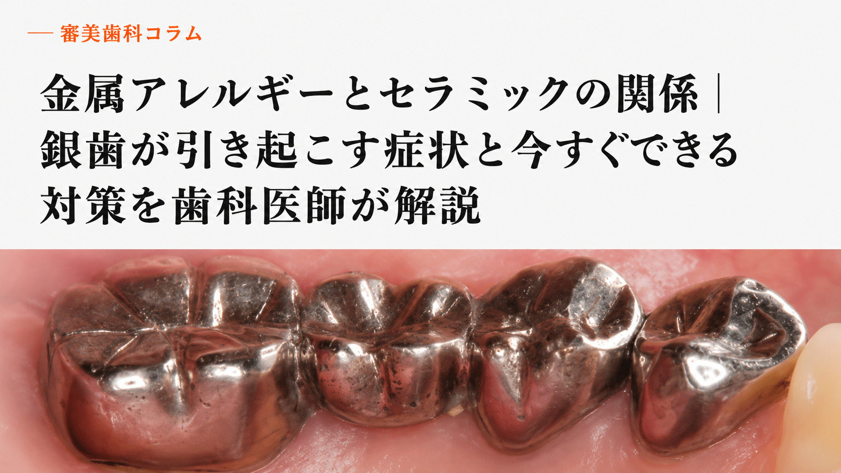 銀歯の金属アレルギーとは？症状・検査・セラミック対策を解説