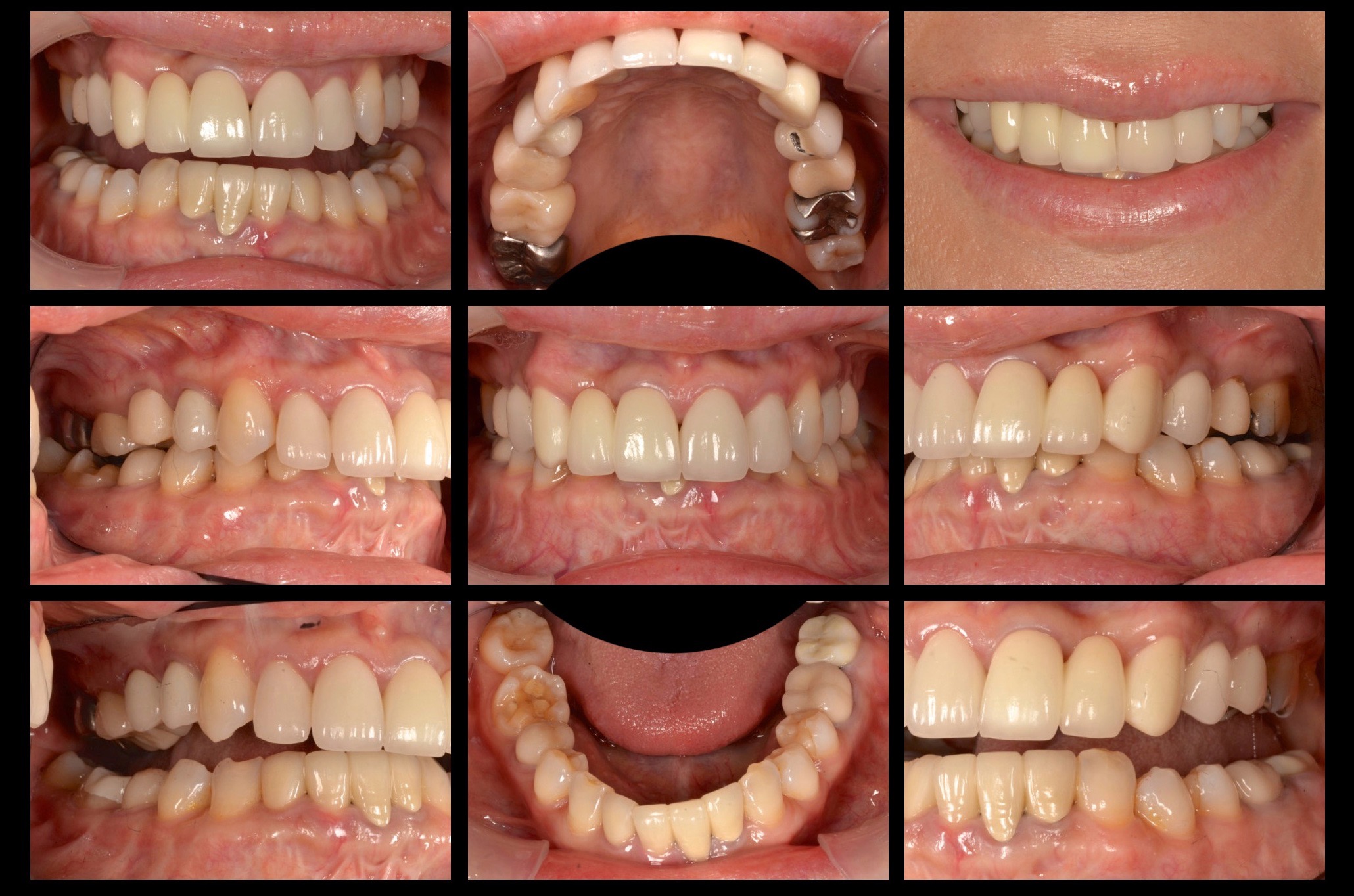 大きく変えた歯科治療。【かみ合わせ・セラミック治療例】50代女性　s621.2015122