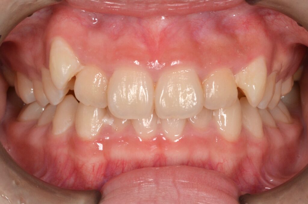  八重歯を治したい。【ワイヤー矯正治療例】10代女性　o1789.20210510 