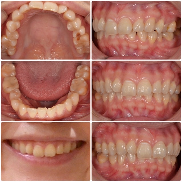 歯並びを治したい、悪いところは全て治したい　20代女性　2024.5.22