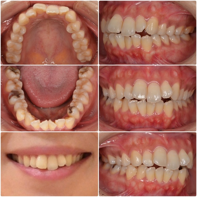 歯並びを綺麗に治したい　30代女性　2024.6.24