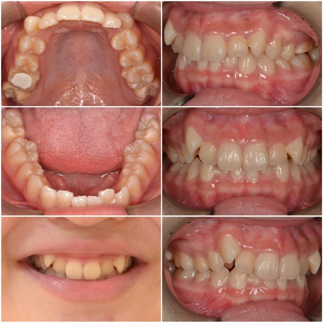 噛み合わせが悪い　10代女性　2024.7.12