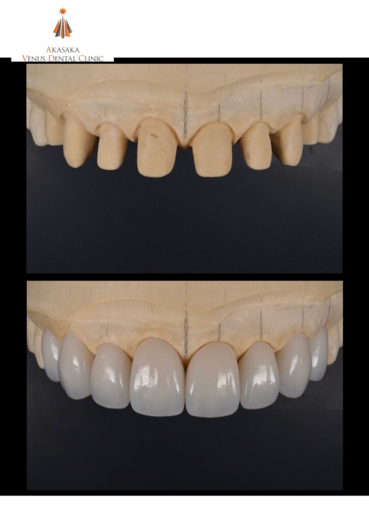 ヴィーナスクラウンを製作しました。2024.10.28
