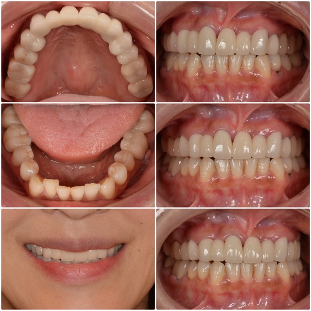 セラミックをやり直したい　40代女性　2024.11.13