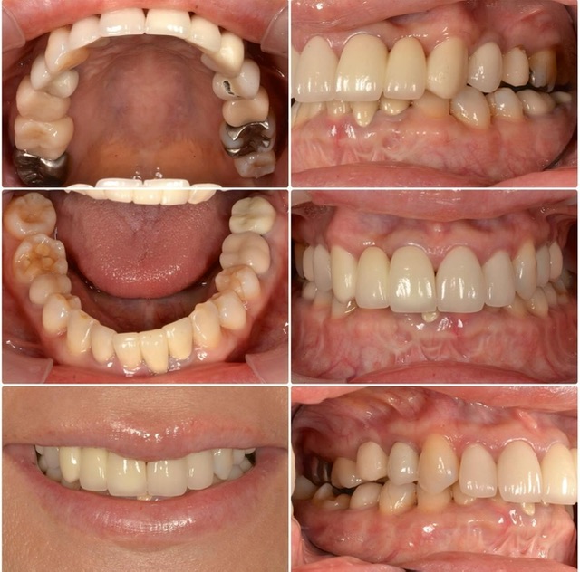 顎が痛い。前歯が長い。2025.1.31