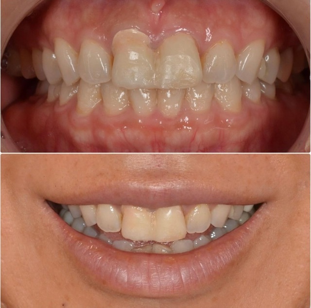上の前歯他院で治療中だが、仮歯が気になる2025.2.14