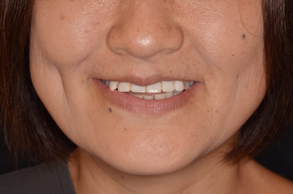 全顎かみ合わせ症例。【セラミック治療例】50代女性　i1988.20220902