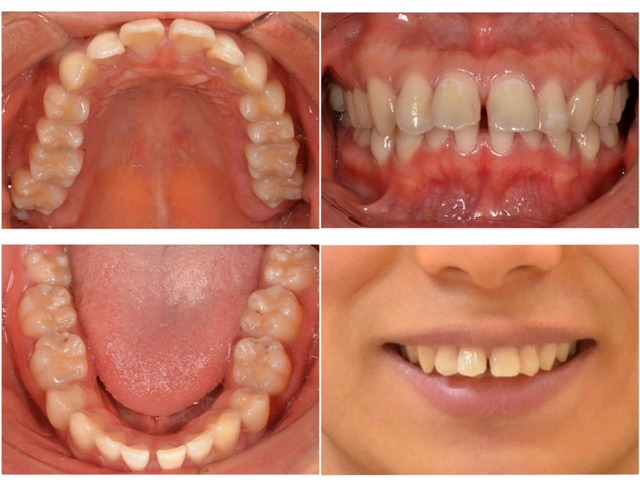歯並びを綺麗にしたい2025.3.3