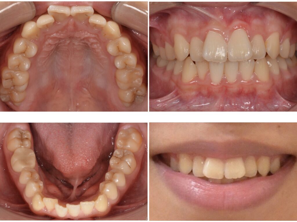 歯並びを治したい　10代男性　2025.3.13