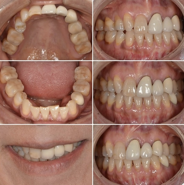 セラミック希望　50代女性　2025.4.15