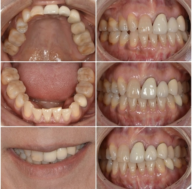 歯並びが気になる　50代女性　2025.5.27