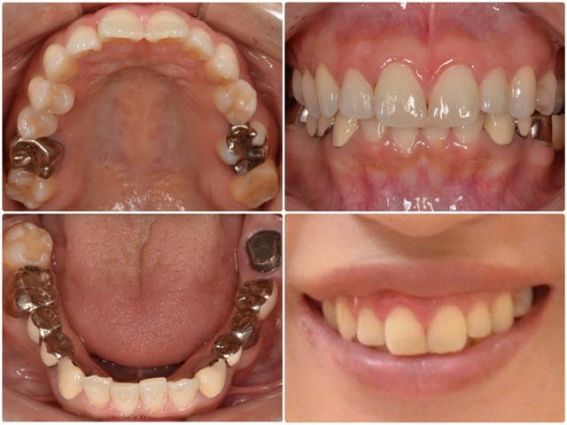 矯正、インプラント治療をしたい。30代女性　2025.6.13