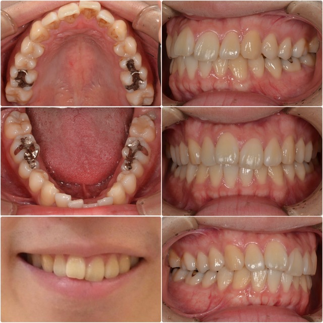 歯並びを治したい　30代男性　2025.6.19