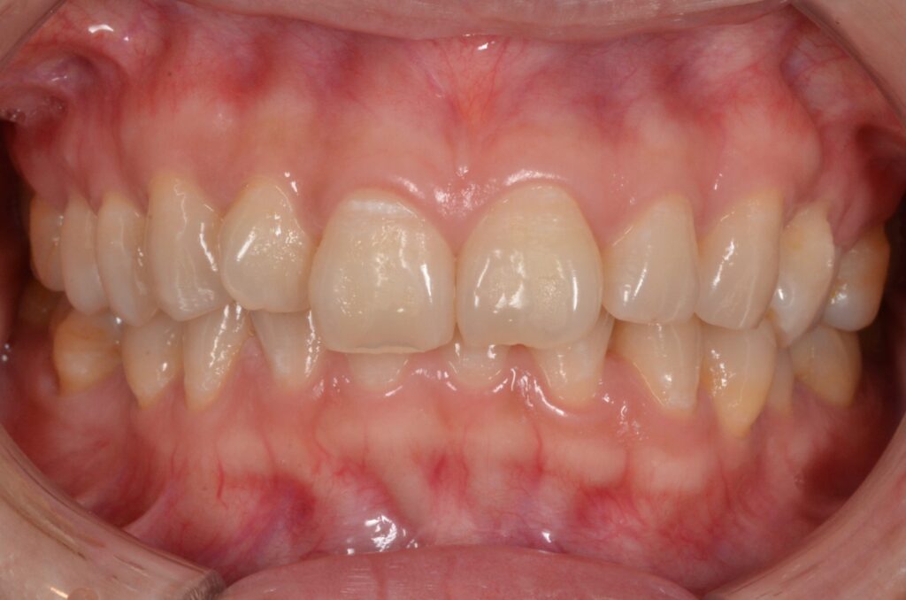 歯並びを治したい。【ワイヤー矯正治療例】30代女性　s1825.20210705