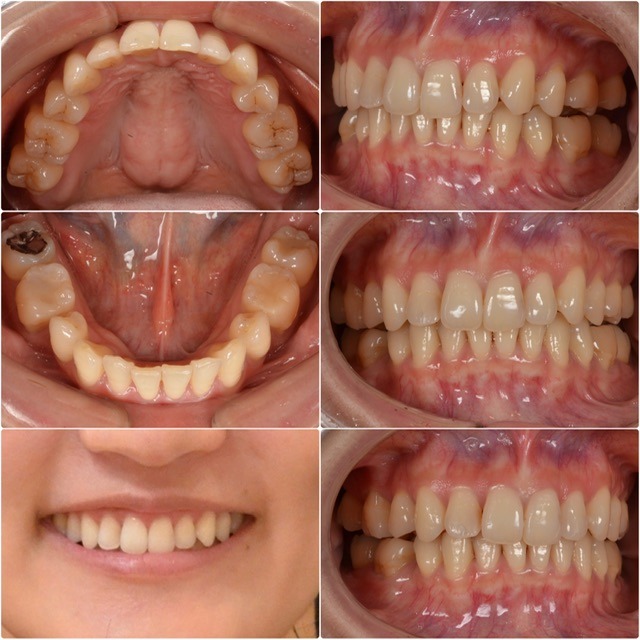 前歯の色と噛み合わせを改善したい2025.8.4