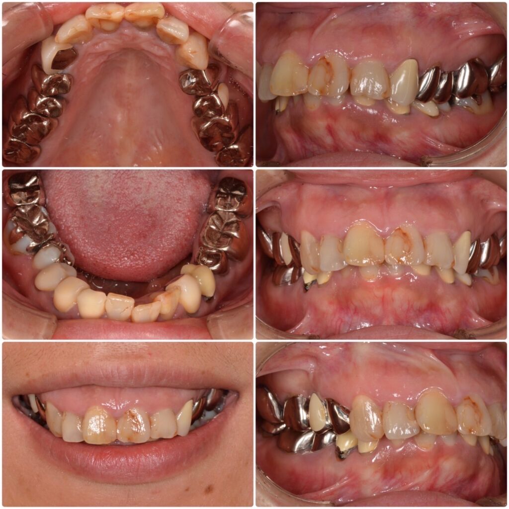 虫歯が痛い。前歯を綺麗にしたい。30代女性　2025.8.18