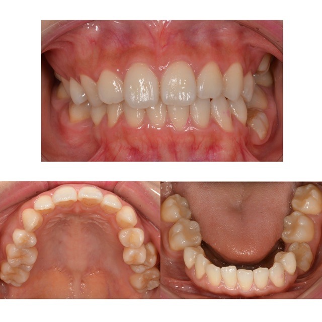 歯並びを治したい　30代女性　2025.8.21