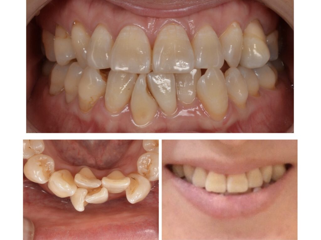 歯並びを治したい　50代女性　2025.8.29