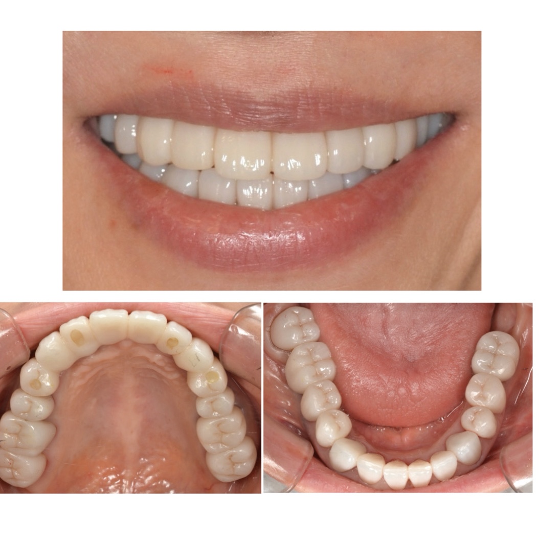  他院のセラミックをやり直したい　40代女性　2026.4.21 