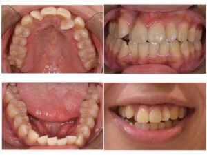 歯並びを治したい　20代女性　2025.12.11