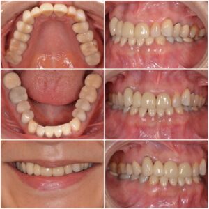 カカオポリフェノールと虫歯の関係　2026.02.19