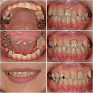 白い歯にするならセラミックという選択　2026.03.18