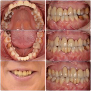 仮歯について　2026.03.25