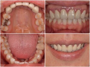 セラミック治療が選ばれる理由　2026.04.01