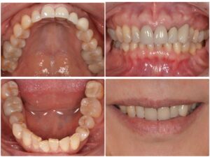 前歯がぐらぐらする　60代女性　2026.4.6