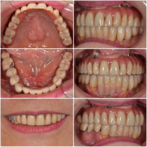 他院のインプラントをやり直したい　70代女性　2026.4.17