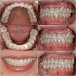 他院のセラミックをやり直したい　40代女性　2026.4.21