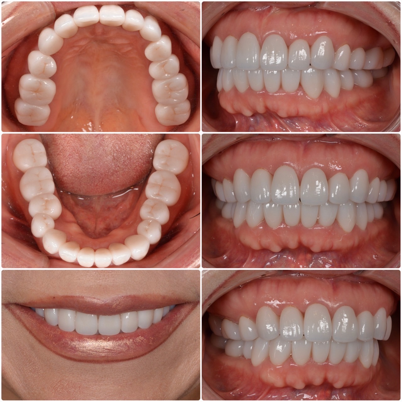  白い歯にする方法　2026.04.22 