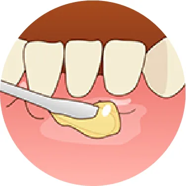 麻酔前の表面麻酔