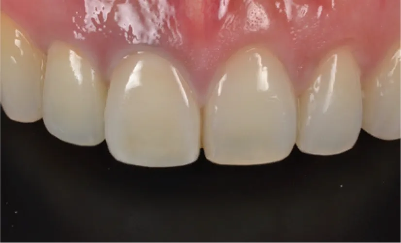 天然歯のような仕上がり