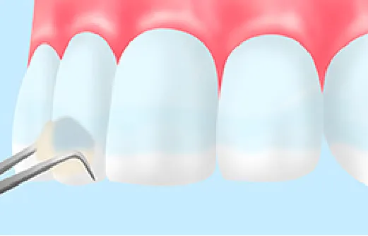 フッ素塗布について