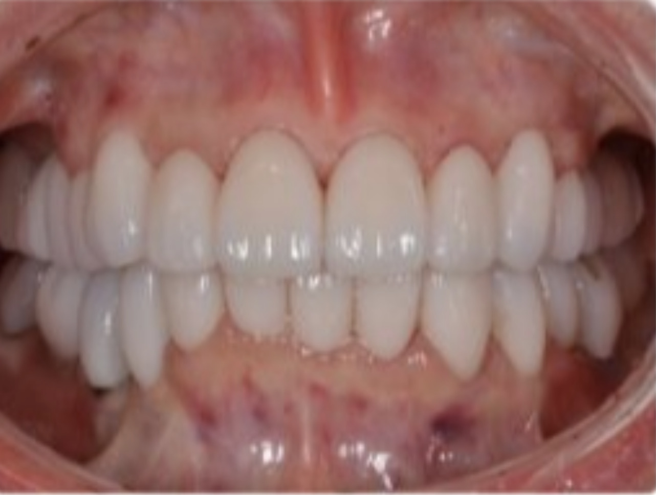  虫歯とインプラントの治療をしたい　50代女性　2026.4.22 