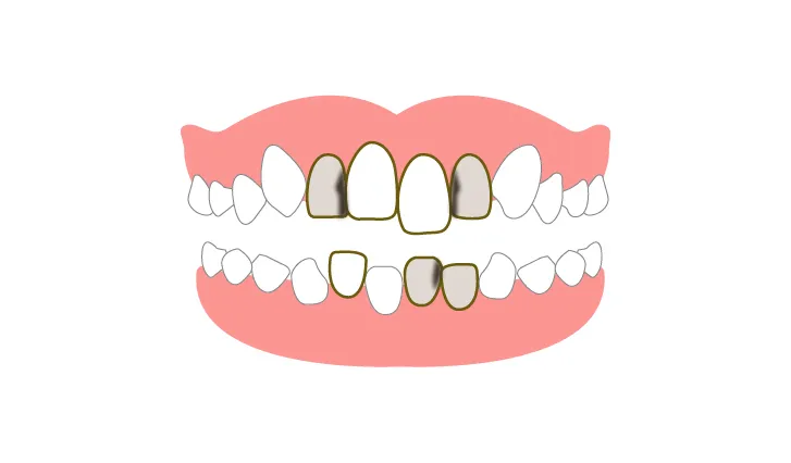 歯並びが悪いため、虫歯や歯周病になっているもの