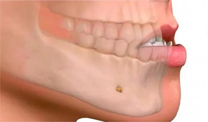 骨格的に噛み合わせがずれているもの