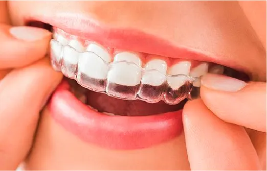 マウスピース型矯正