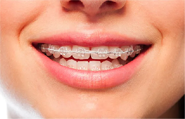 矯正装置を装着