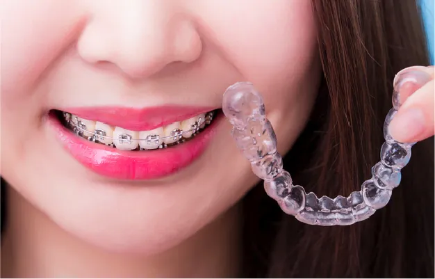 リテーナー装着