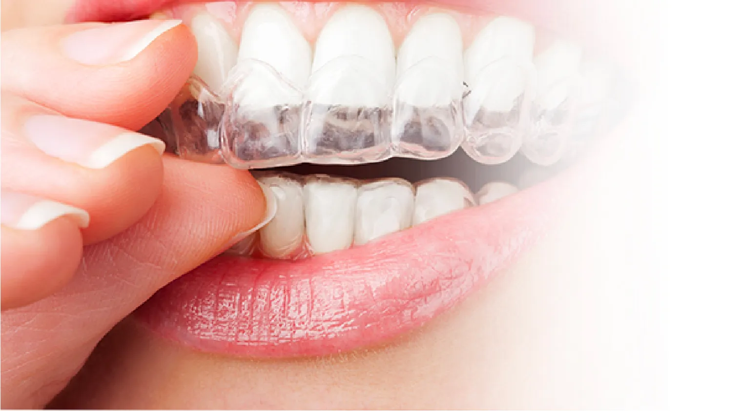 マウスピースによる部分矯正