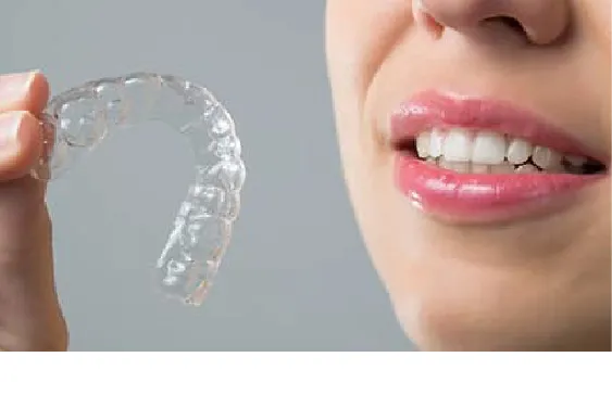 マウスピース型矯正ゴー（前歯の部分矯正）