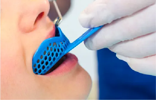 トレー（マウスピース）型取り