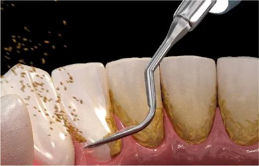 歯石除去（スケーリング）