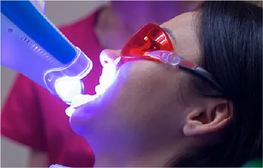 オフィスホワイトニング（約１時間）