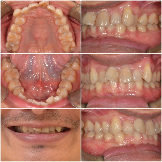 歯並びが気になる　40代男性　2024.6.12