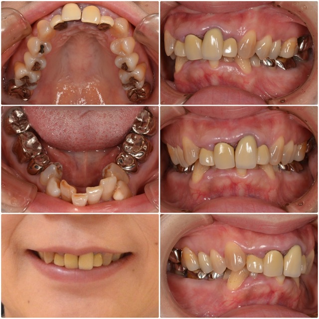 前歯が腫れやすい 50代女性　2024.7.3